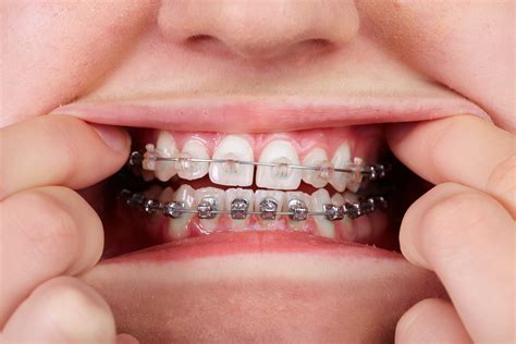 metal brackets in orthodontics|metal braces with clear bands.